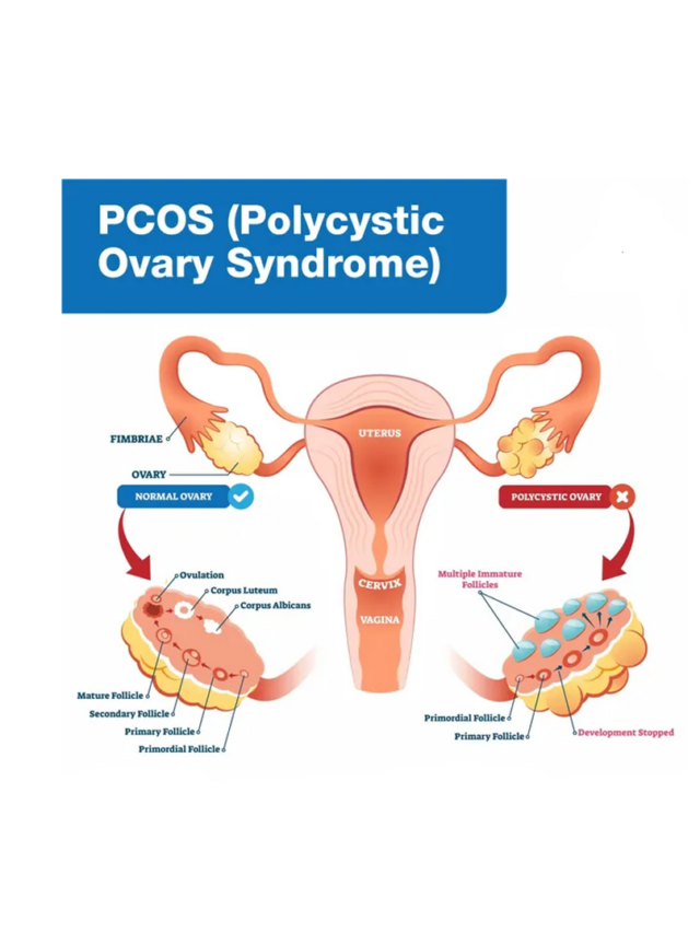 Polycystic Ovarian Disease (Pcod): What Is Pcod? - Sharda Narayan Hospital